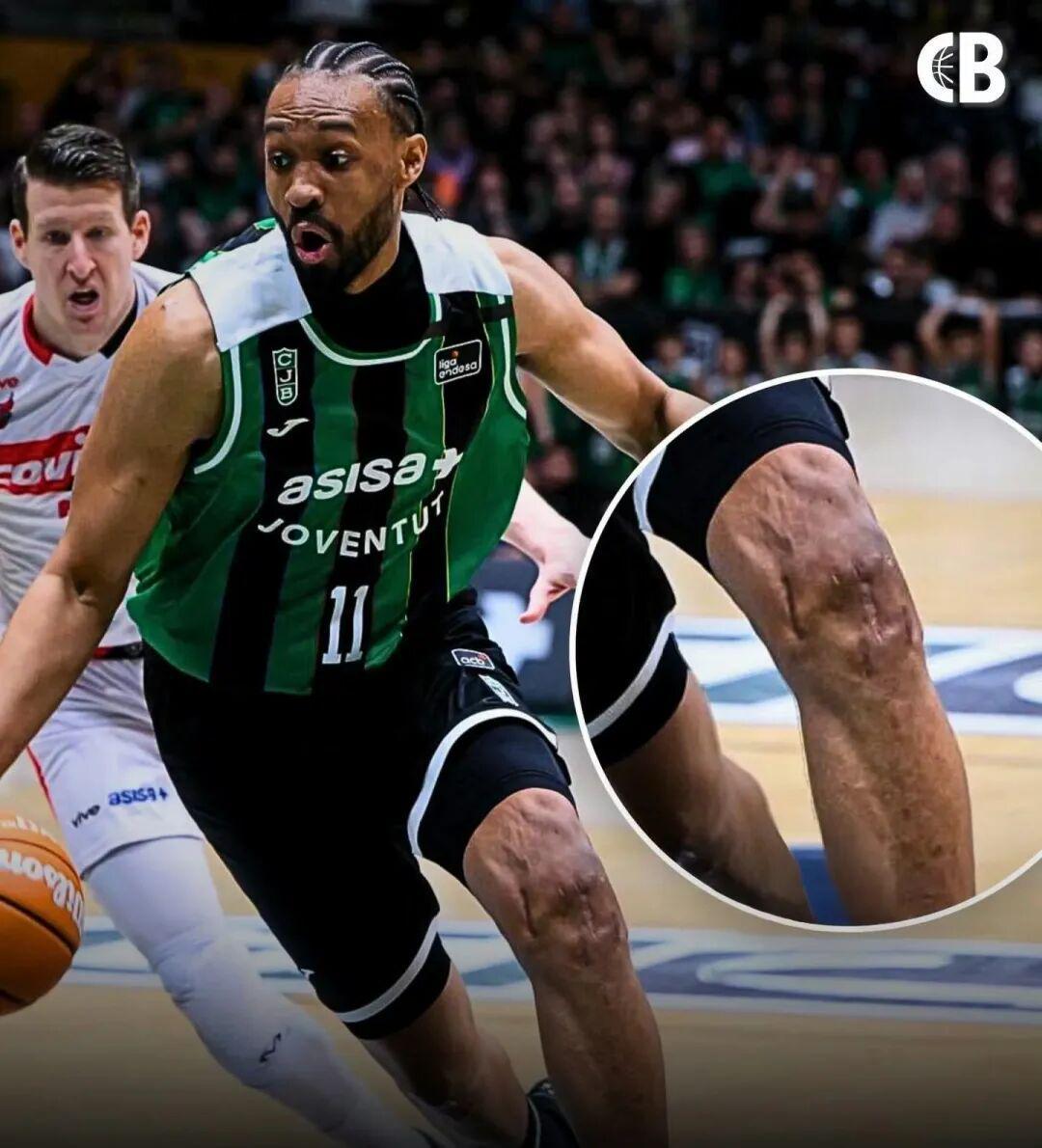 世界杯直播客户端升级-好可怕的膝盖！两次ACL撕裂，他还在打球！！！